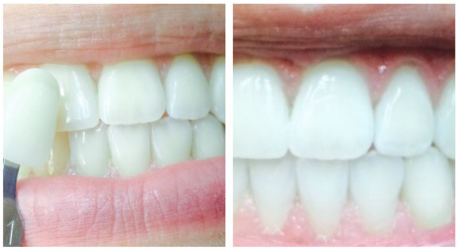 In office whitening case 